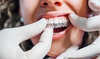 Dentist placing clear aligner on patient's top teeth