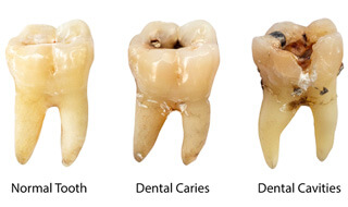 various stages of tooth decay